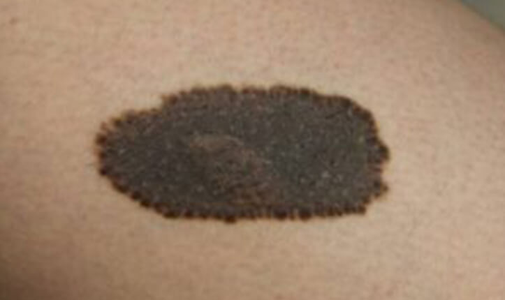 色素性母斑（ホクロ）