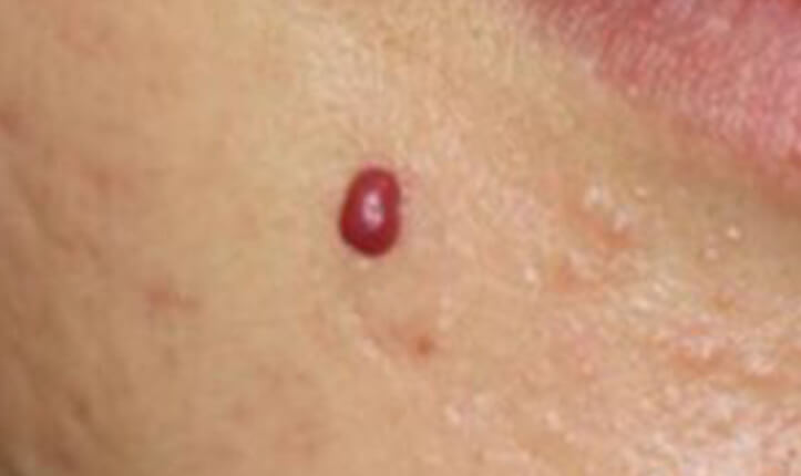 血管拡張性肉芽腫