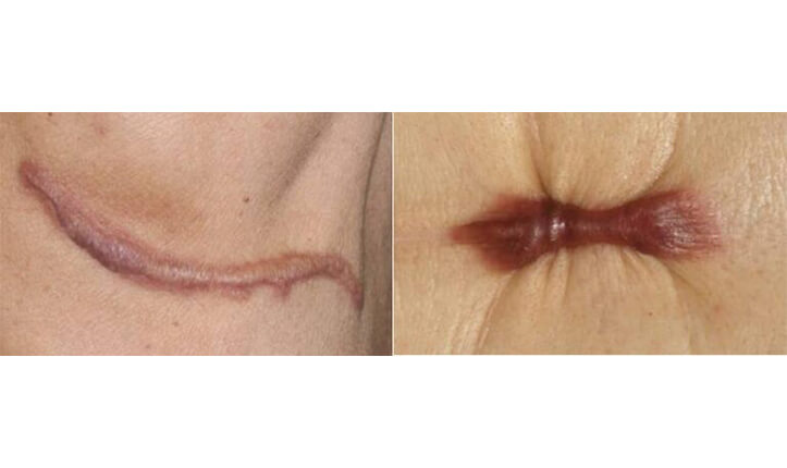 肥厚性瘢痕・ケロイド