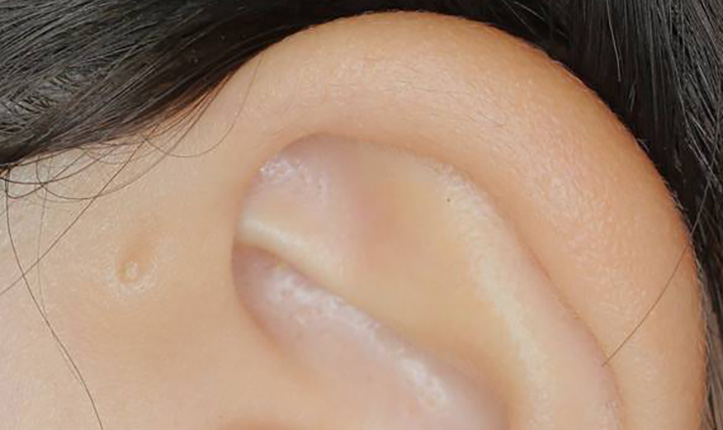 耳瘻孔