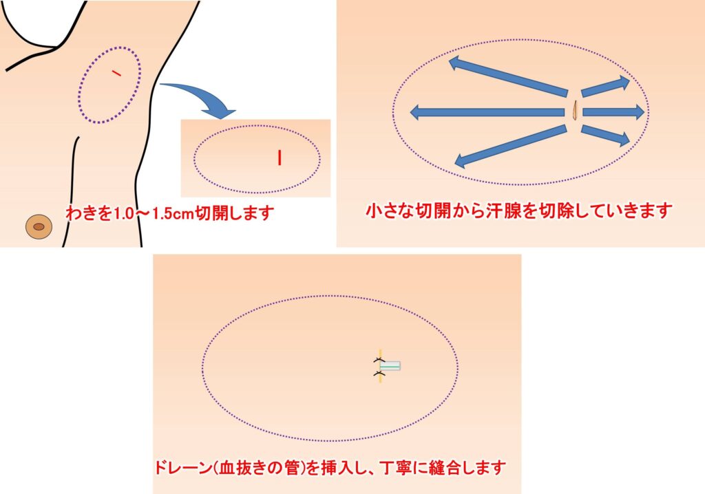 当院の腋臭症(わきが)・腋窩多汗症手術の特徴｜クリニックひいらぎ皮膚科形成外科｜池尻大橋・渋谷・三軒茶屋