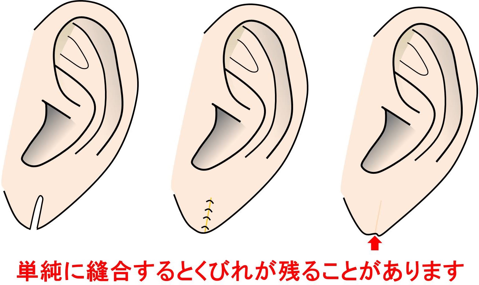 耳垂裂（じすいれつ） 2カ所以上切れていても治療可能です | 神楽坂肌と爪のクリニック
