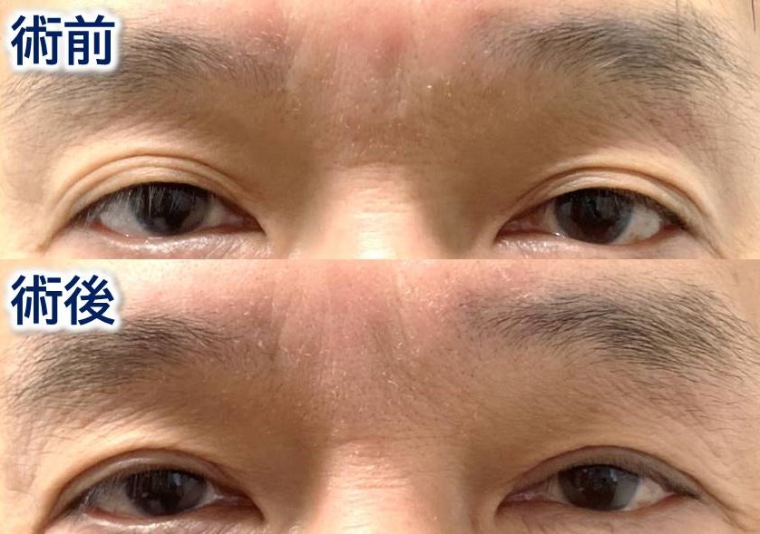 三重瞼は眼瞼下垂の症状の1つです|クリニックひいらぎ皮膚科形成外科|池尻大橋・渋谷・三軒茶屋