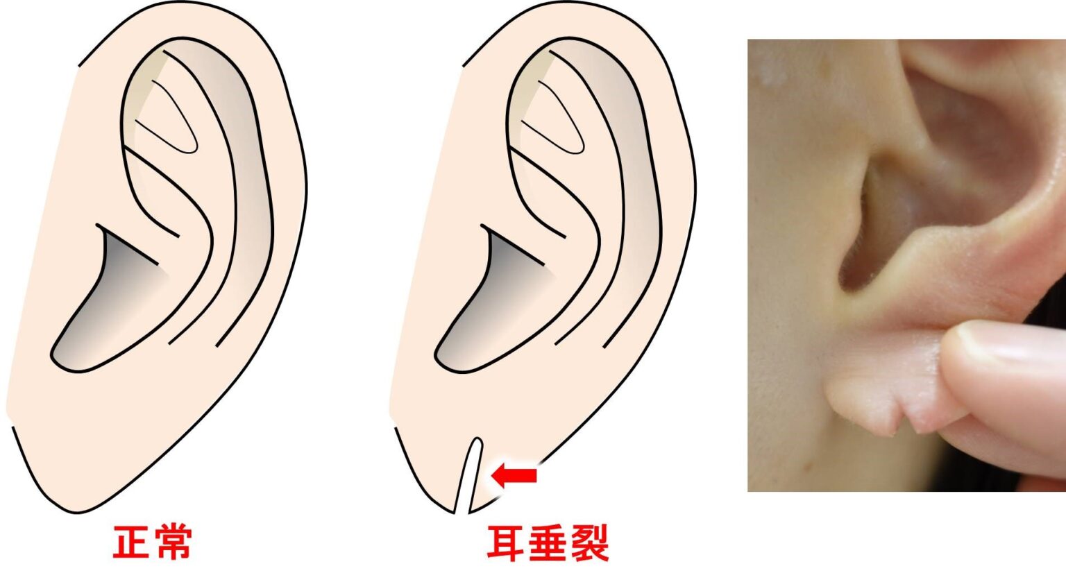 第二十二节 耳畸形及缺损的整复术-口腔科学-医学