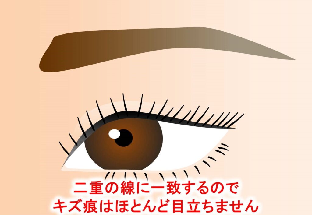 三重瞼は眼瞼下垂の症状の1つです|クリニックひいらぎ皮膚科形成外科|池尻大橋・渋谷・三軒茶屋