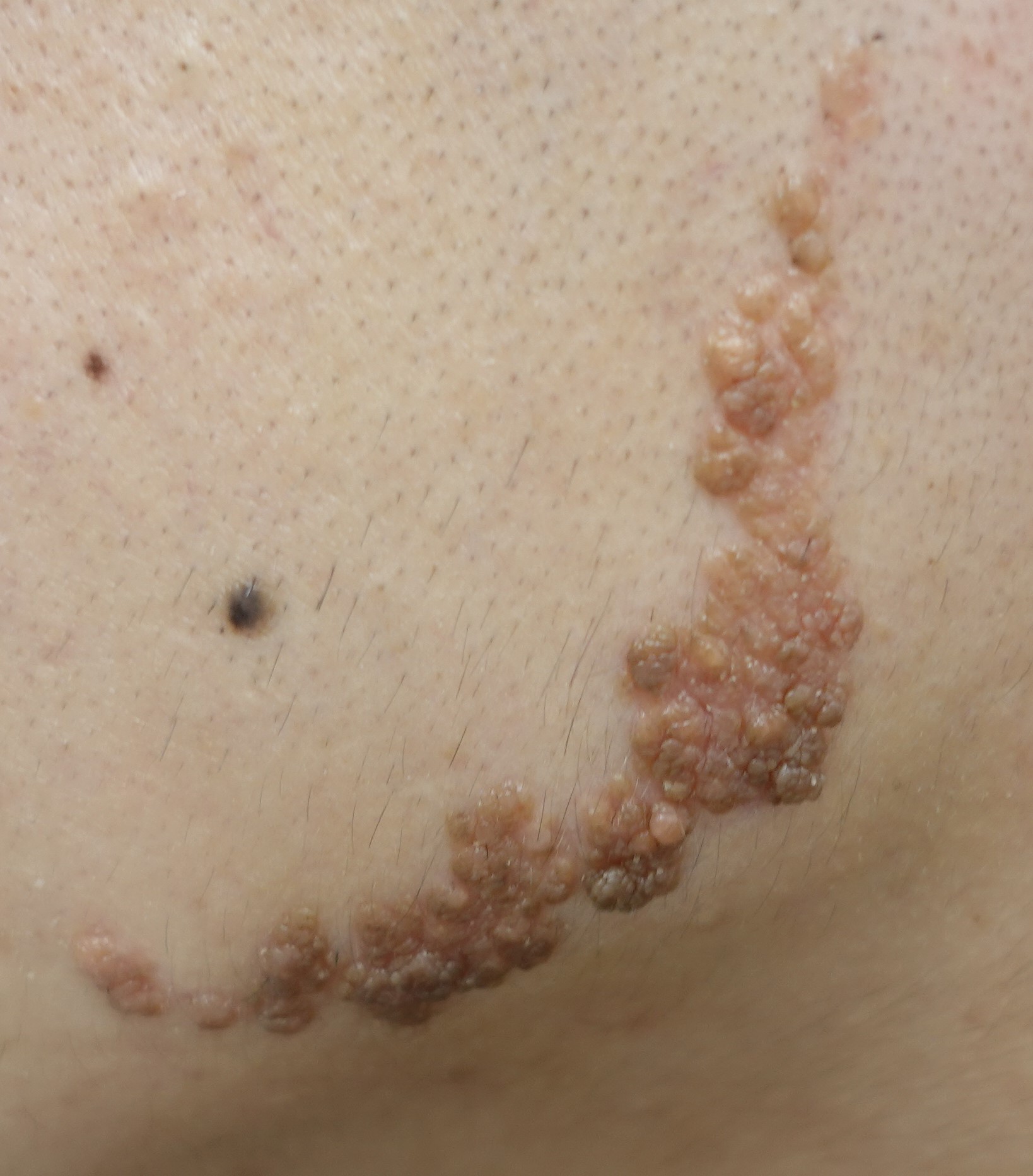 表皮母斑｜クリニックひいらぎ皮膚科形成外科｜池尻大橋・渋谷・三軒茶屋