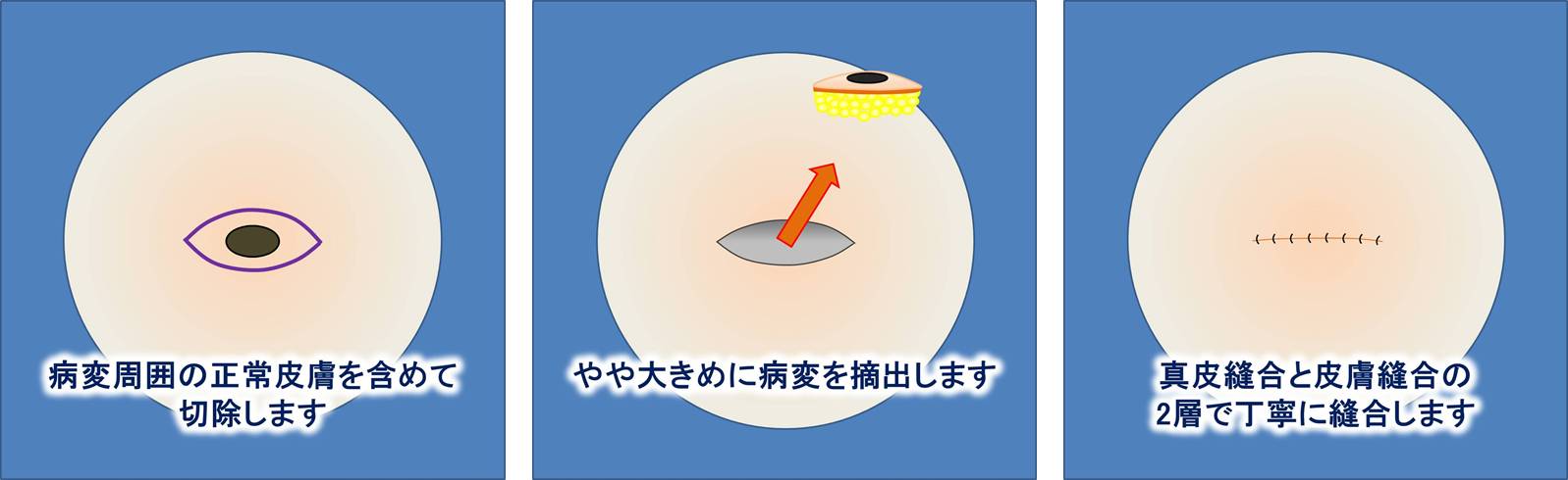 基底細胞癌|クリニックひいらぎ皮膚科形成外科|池尻大橋・渋谷・三軒茶屋