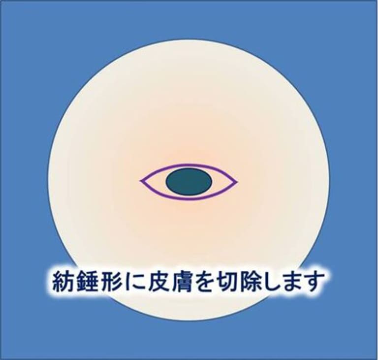 紡錘形に皮膚を切除します