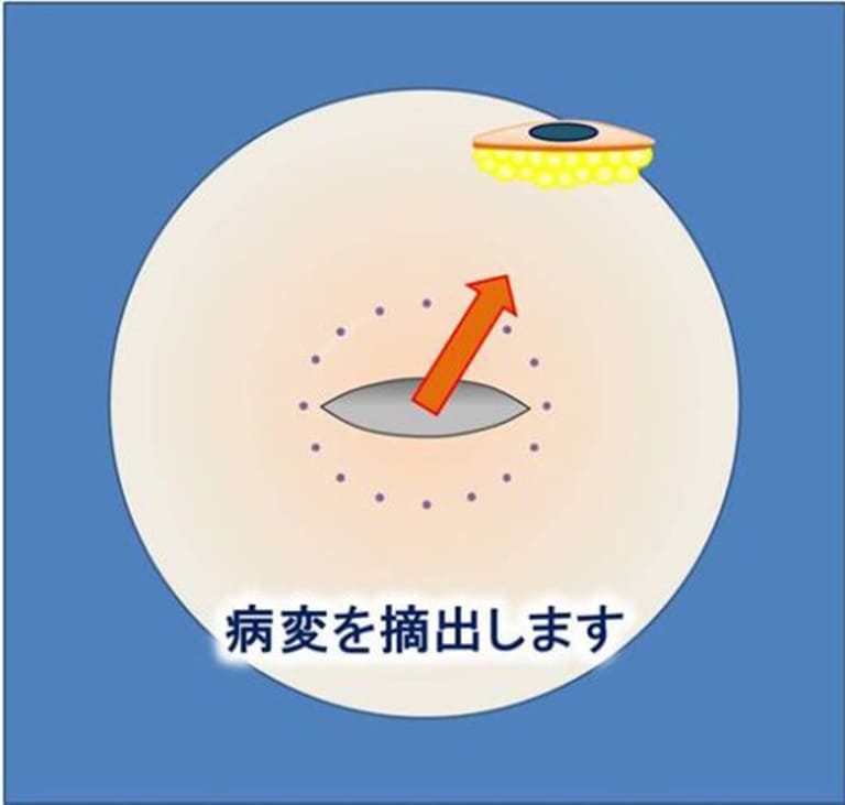 病変を摘出します