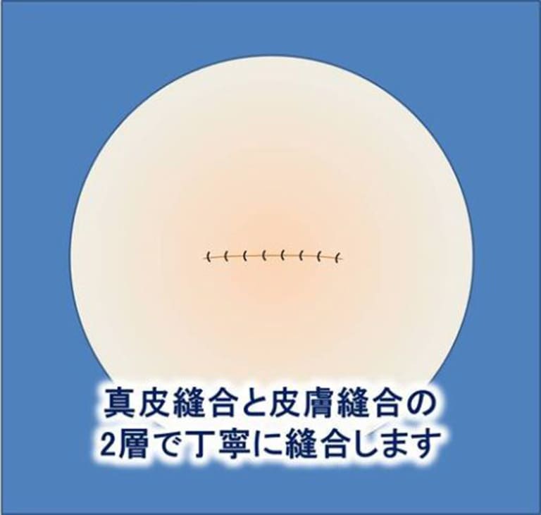 真皮縫合と皮膚縫合の2層で丁寧に縫合します
